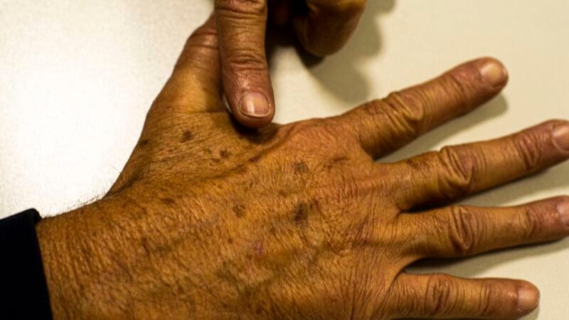 Lacunas nos Dados sobre Câncer de Pele Comprometem Diagnóstico e Tratamento no Brasil