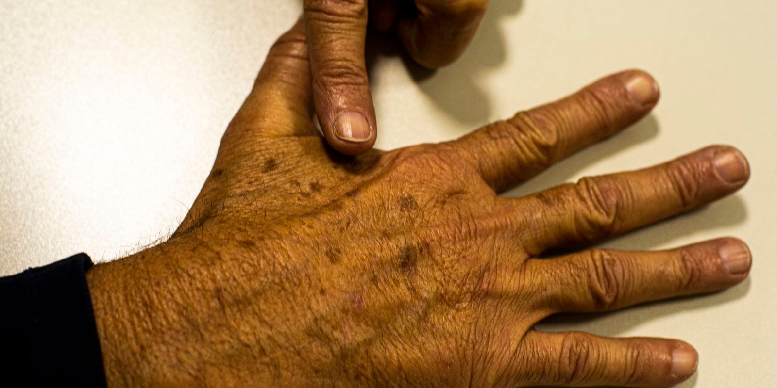 Lacunas nos Dados sobre Câncer de Pele Comprometem Diagnóstico e Tratamento no Brasil