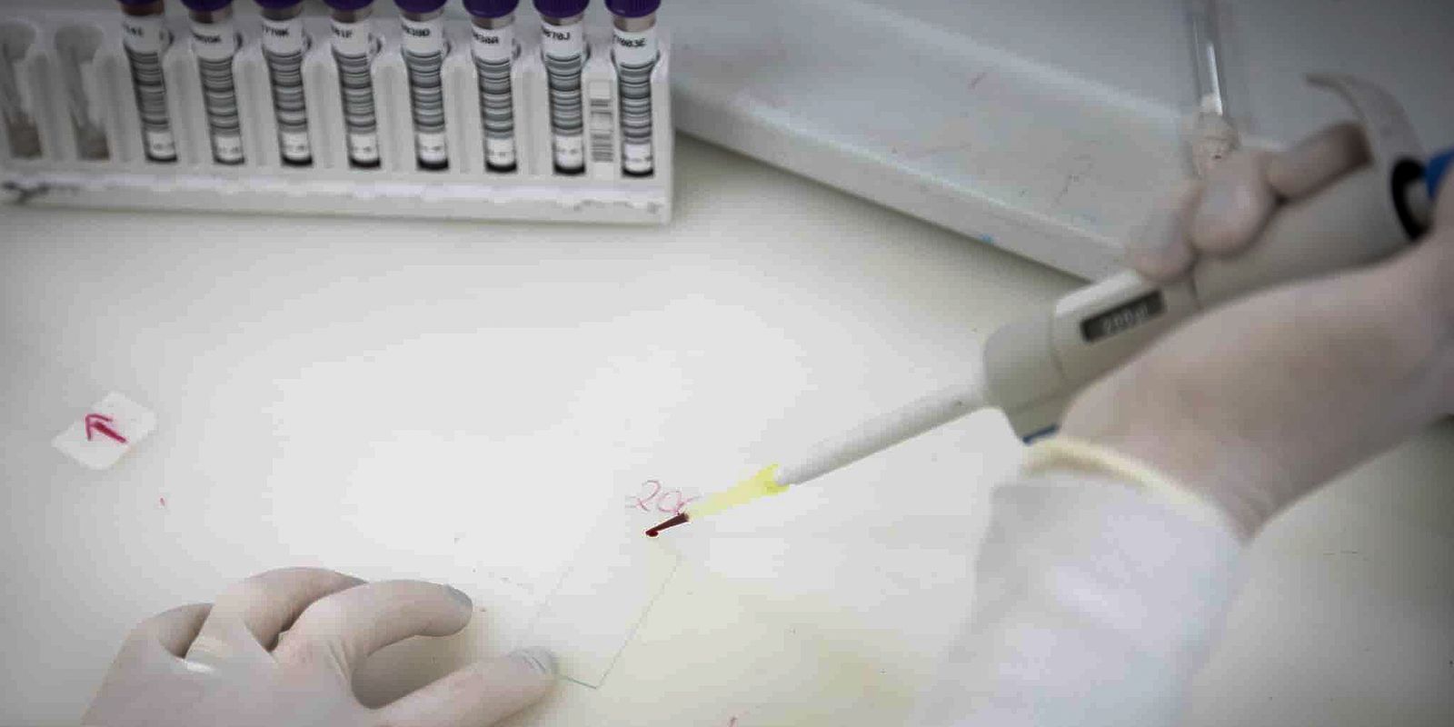 Homem em São Paulo Testa Positivo para Meningite Após Suspeita de Ebola
