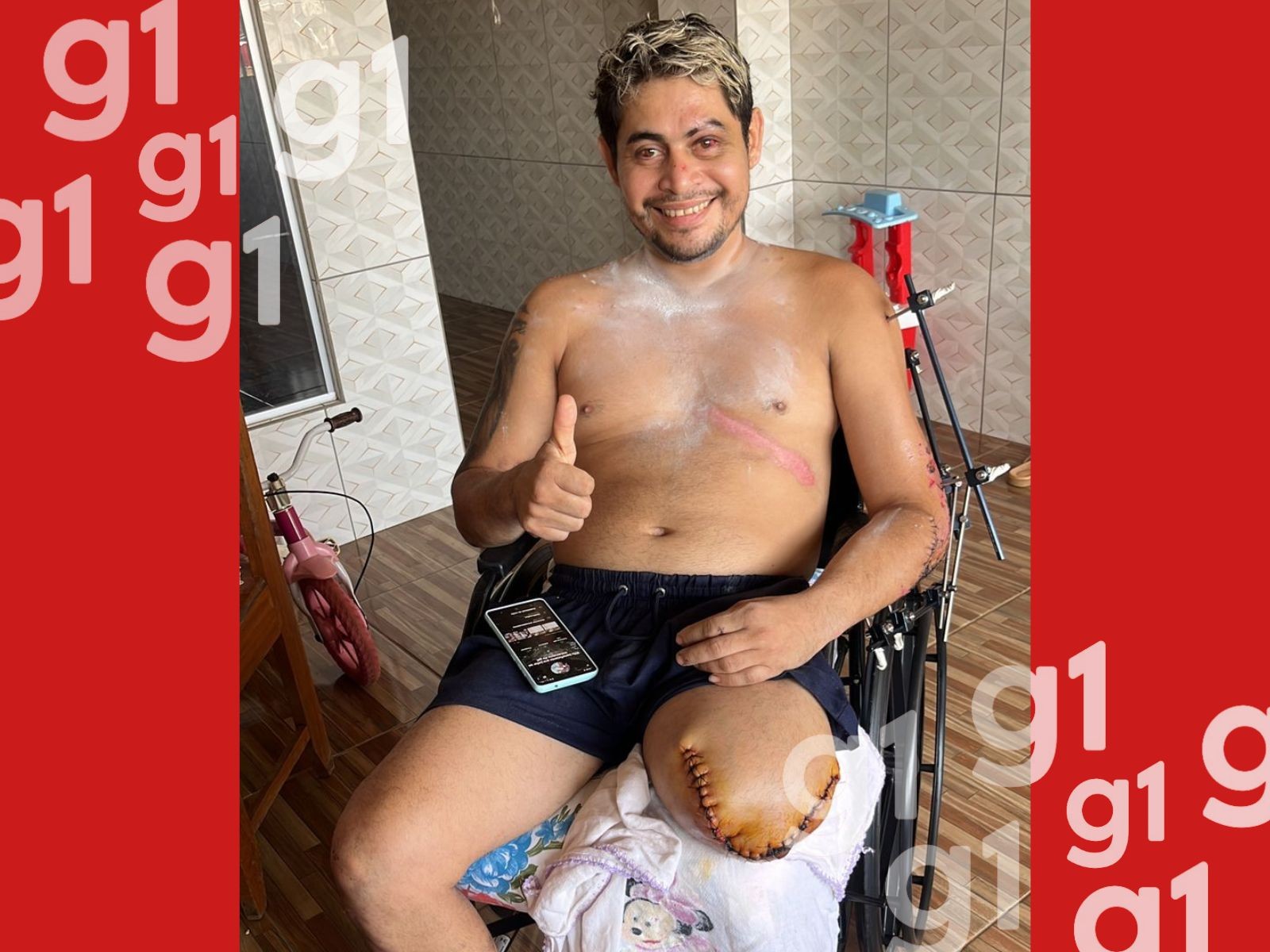 Motociclista Enfrenta Desafios Financeiros Após Acidente Grave no Acre